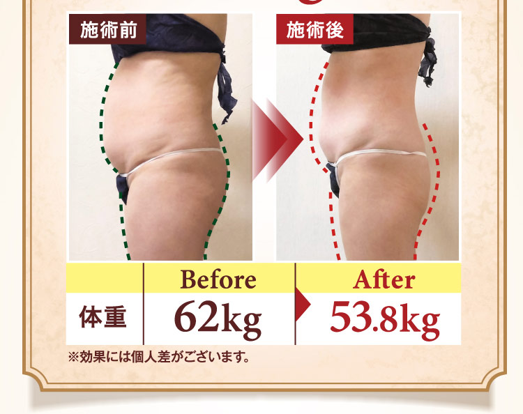 施術前と施術後の比較写真。体重 Before 62kg から After 53.8kg に変化。※効果には個人差がございます。