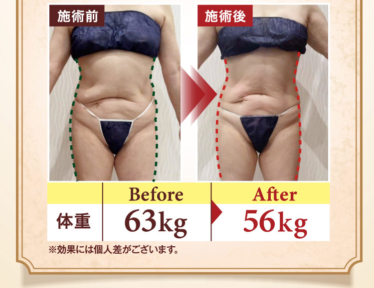 施術前と施術後の比較写真。体重 Before 63kg から After 56kg に変化。※効果には個人差がございます。