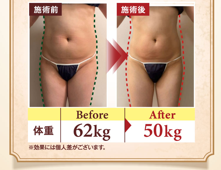 施術前と施術後の比較写真。体重 Before 62kg から After 50kg に変化。※効果には個人差がございます。