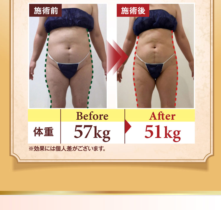 施術前と施術後の比較写真。体重 Before 57kg から After 51kg に変化。※効果には個人差がございます。