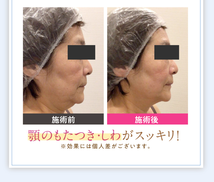 施術された方の実例3
