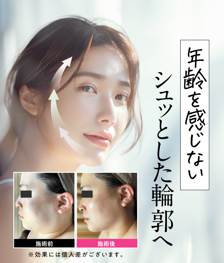 年齢を感じないシュッとした輪郭へ
