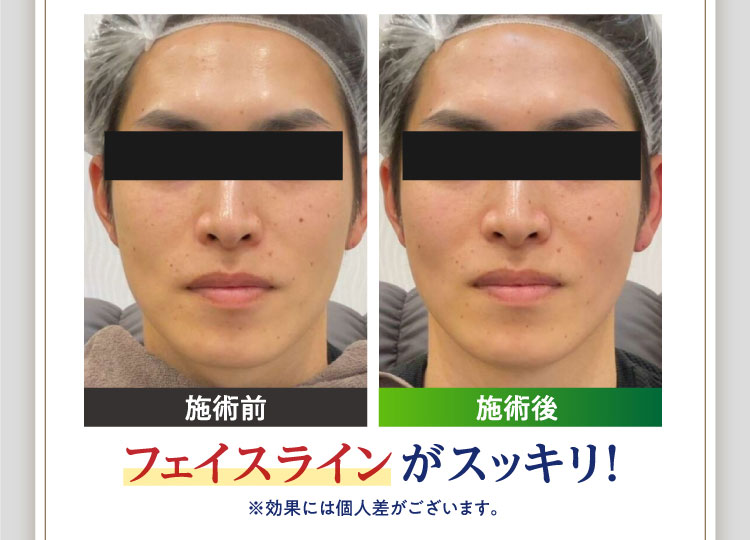 フェイスラインがスッキリ！※効果には個人差がございます。