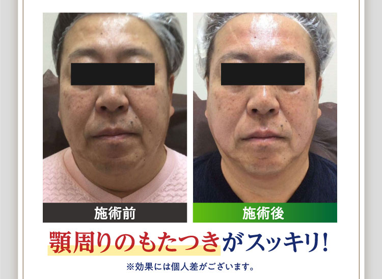 顎周りのもたつきがスッキリ！※効果には個人差がございます。