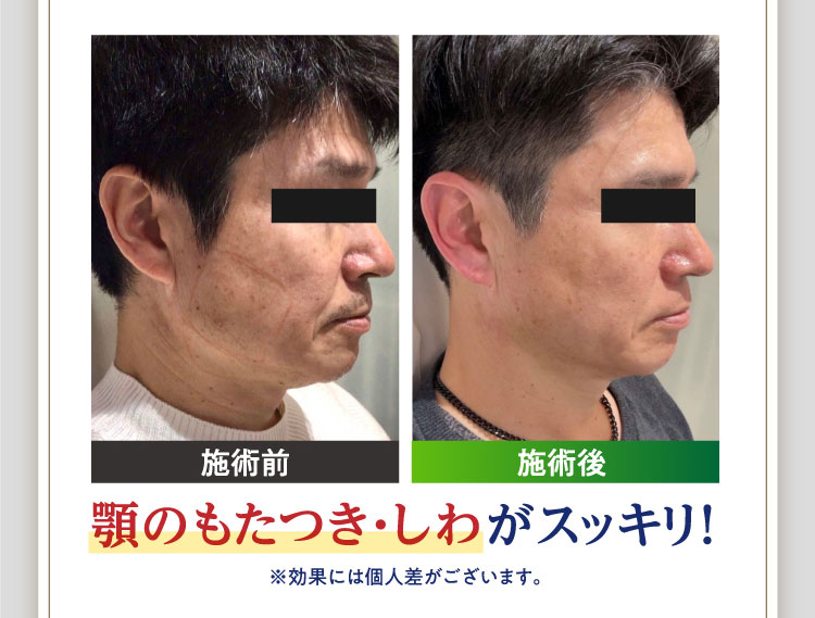 顎のもたつき・しわがスッキリ！※効果には個人差がございます。