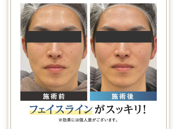施術前 施術後 フェイスラインがスッキリ！ ※効果には個人差がございます。