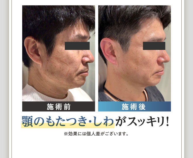 施術前 施術後 顎のもたつき・しわがスッキリ！ ※効果には個人差がございます。