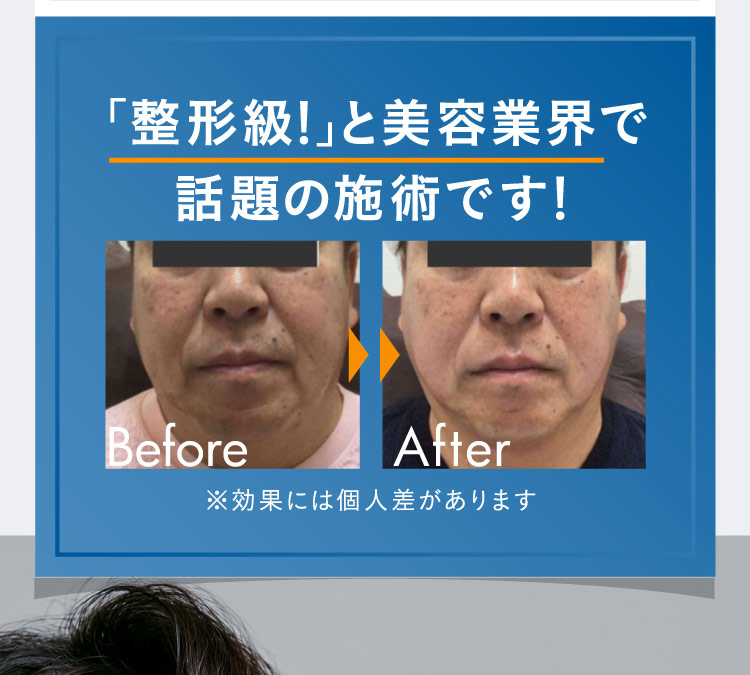 「整形級！」と美容業界で話題の施術です！ Before After ※効果には個人差があります