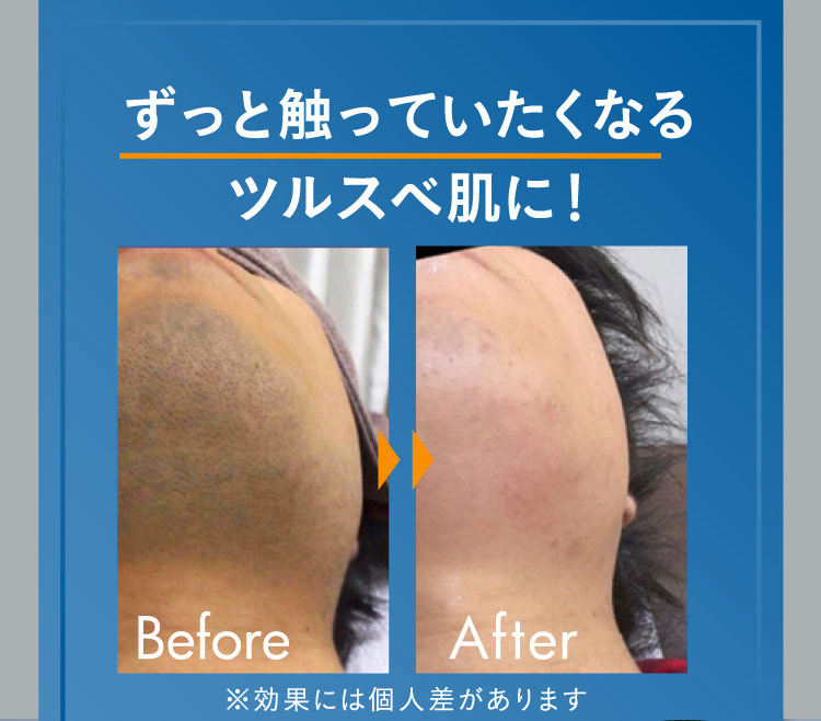 ずっと触っていたくなるツルスベ肌に！ Before After ※効果には個人差があります