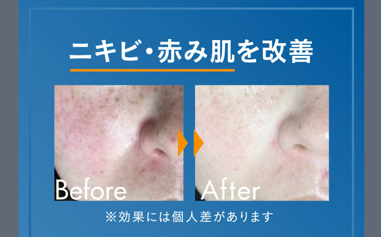 ニキビ・赤み肌を改善 Before After ※効果には個人差があります