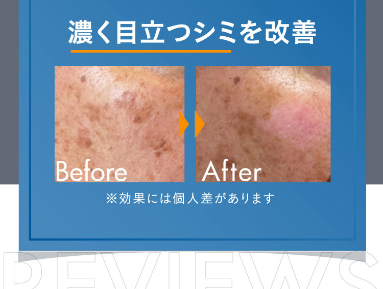 濃く目立つシミを改善 Before After ※効果には個人差があります
